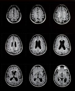 mri of brain showing multiple sclerosis