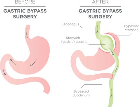 Before and after gastric bypass surgery
