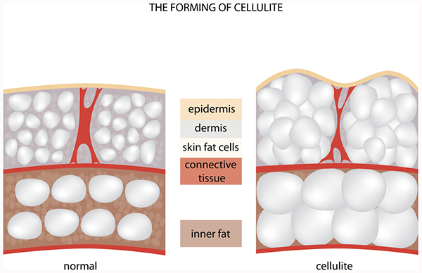 diagram of cellulite cells shows that cellulite forms when there is an excess of fat cells in the skin