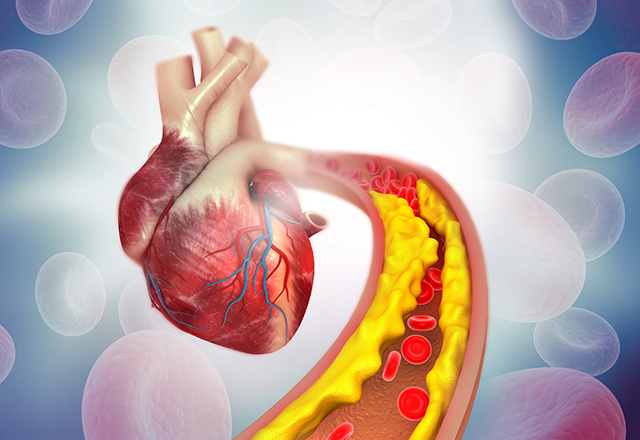 Cholesterol plaque in artery with Human heart anatomy. 3d illustration